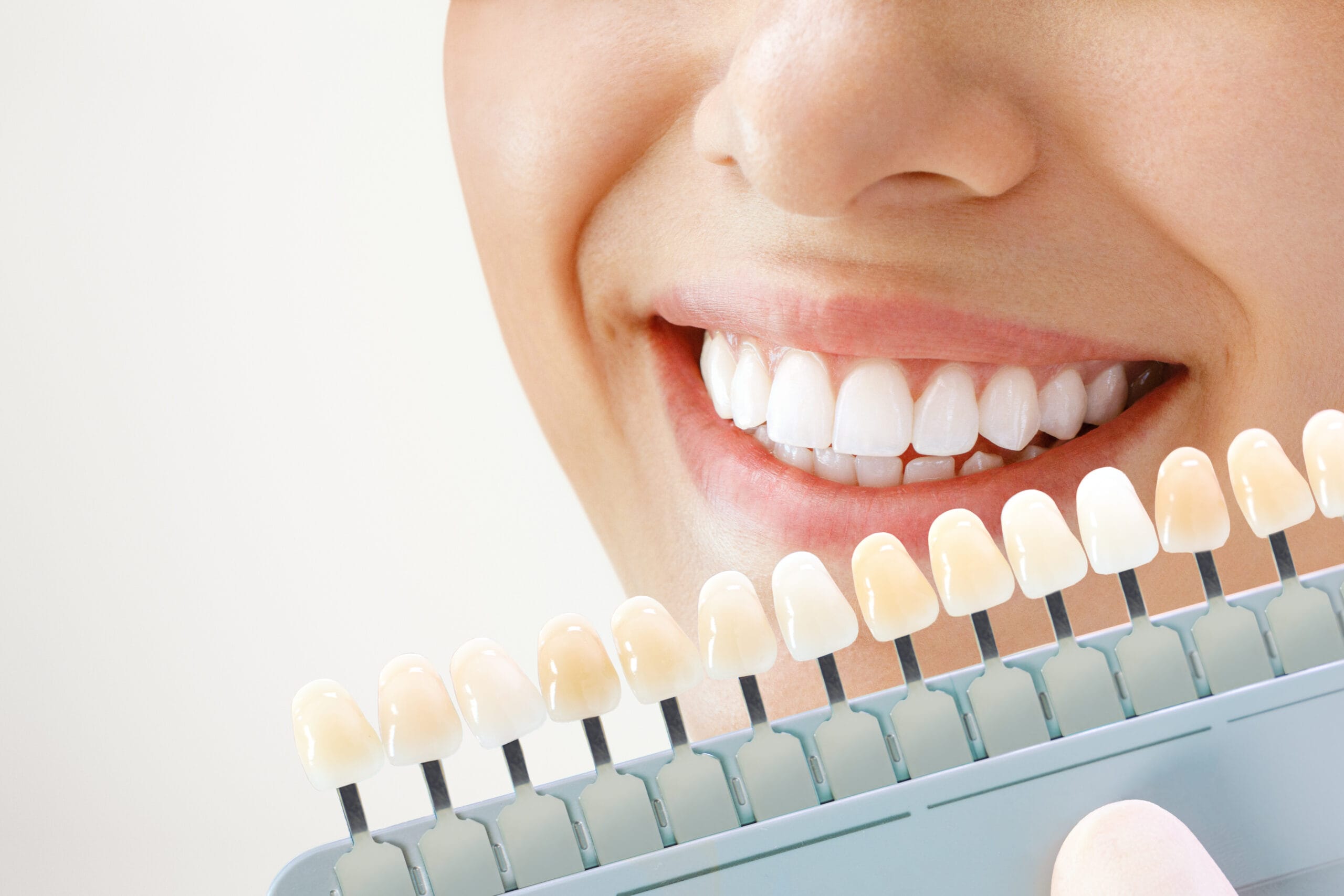 Smiling young woman. Cosmetological teeth whitening in a dental clinic. selection of the tone of the implant tooth Teeth Whitening in Sarnia